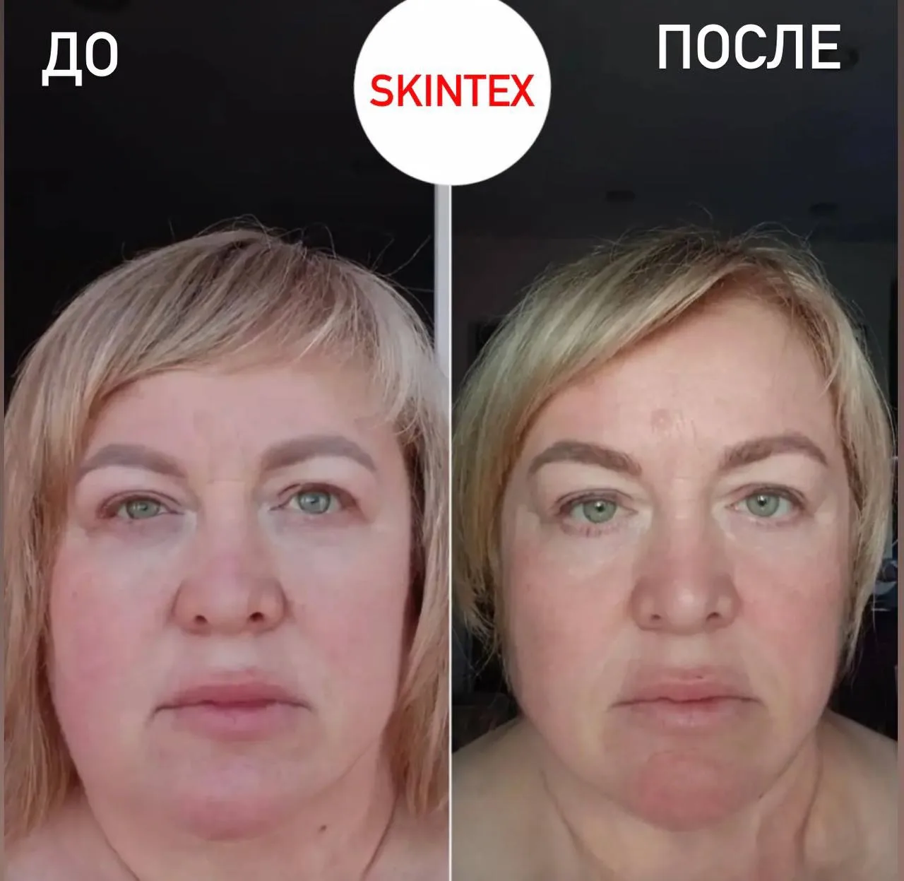 «Худое лицо» без липолитика: естественно и безопасно