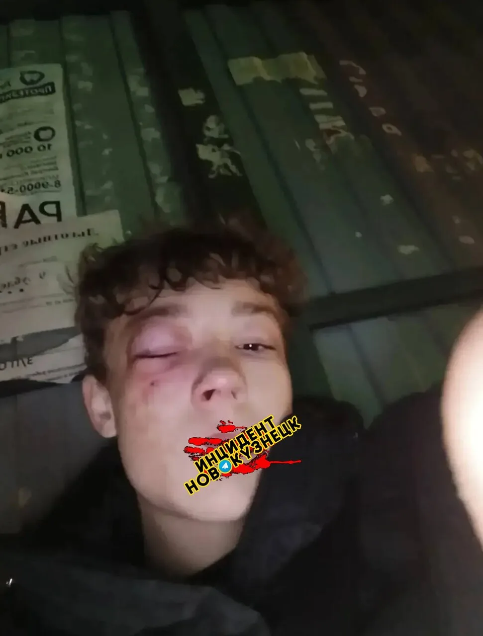 В Новокузнецке пьяные люди избили 14-летнего подростка: у него серьёзные травмы лица