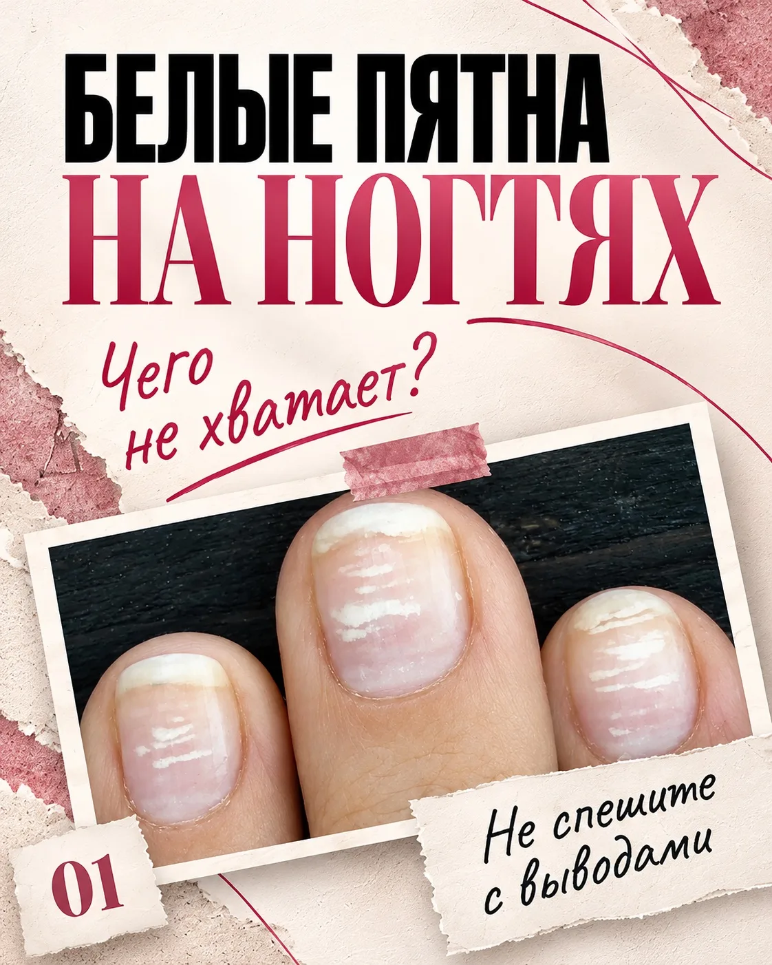 Белые пятна на ногтях — значит, не хватает витаминов? Не спешите с выводами 👀