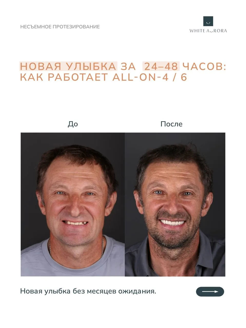 Имплантация по методу All-on-4 / All-on-6 — это не просто эстетика, а уверенность при р...