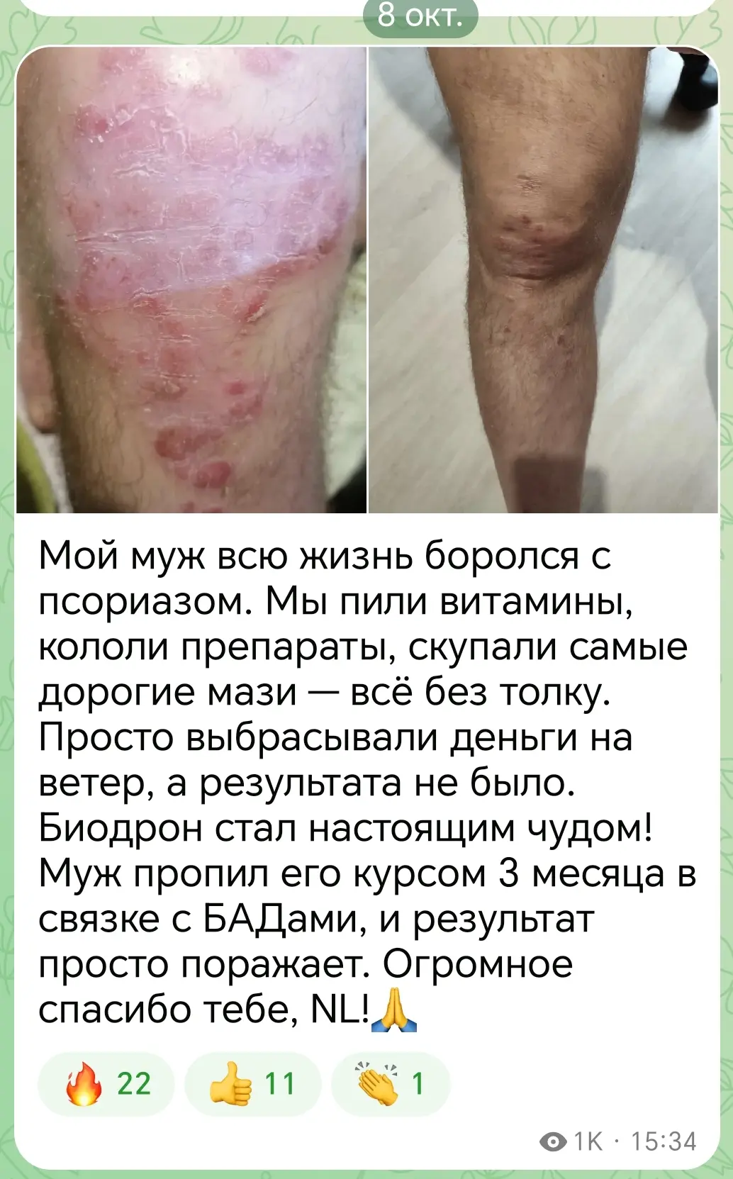 Псориазу.