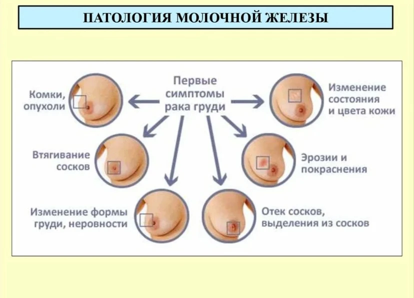 Ранняя диагностика — главный союзник по борьбе с раком груди
