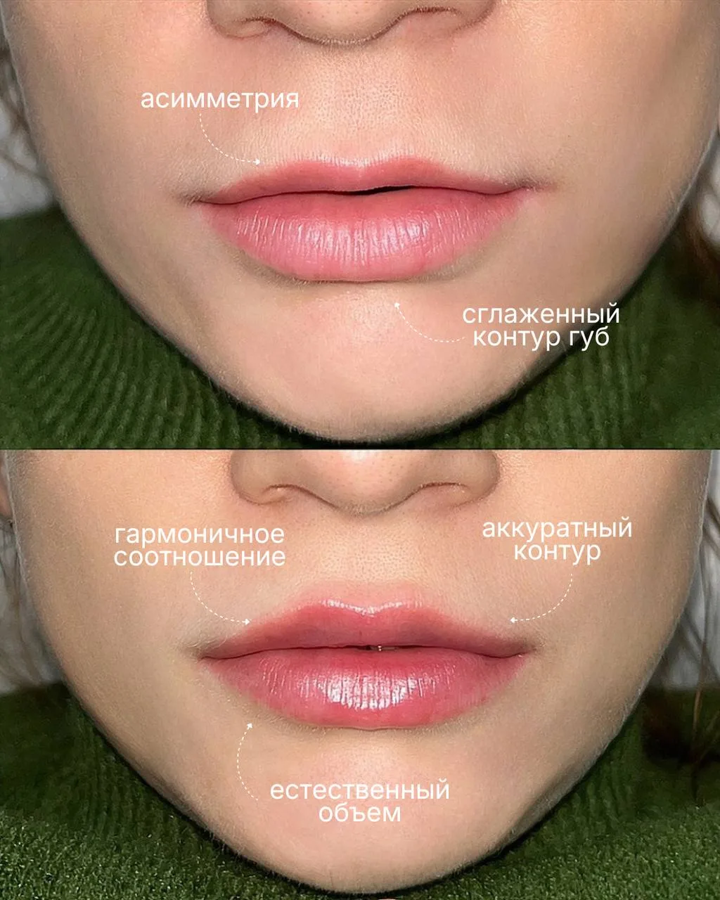 Мягкий объём без эффекта «перекачанных» губ 💋