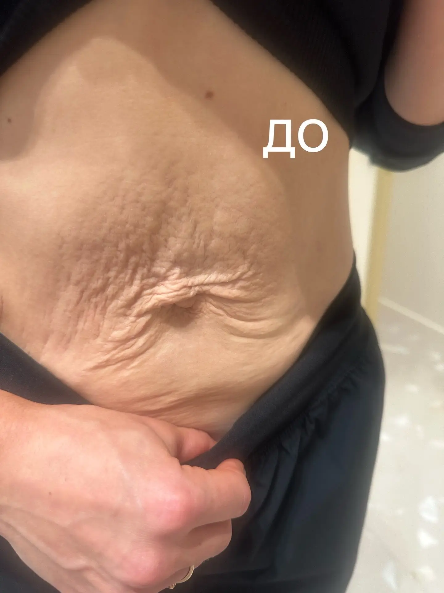 Не устраивает состояние кожи на животе?