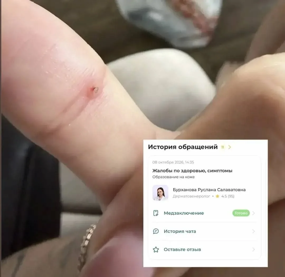 Я обнаружила на пальце какой-то нарост 😳