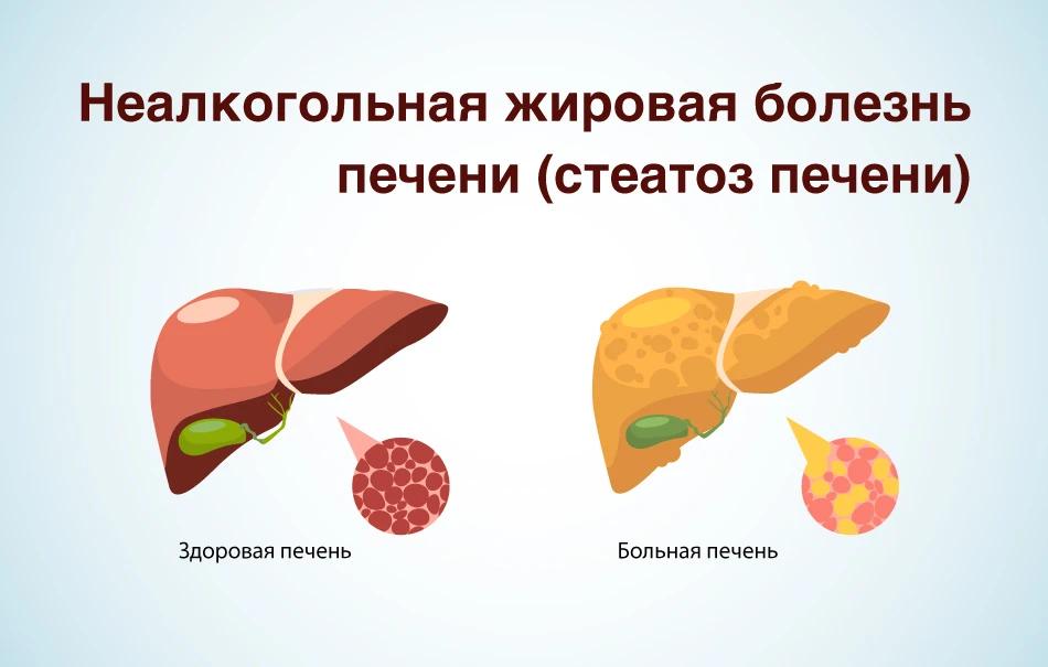 Неалкогольная жировая болезнь печени (НАЖБП) это самое частое хроническое заболевание п...