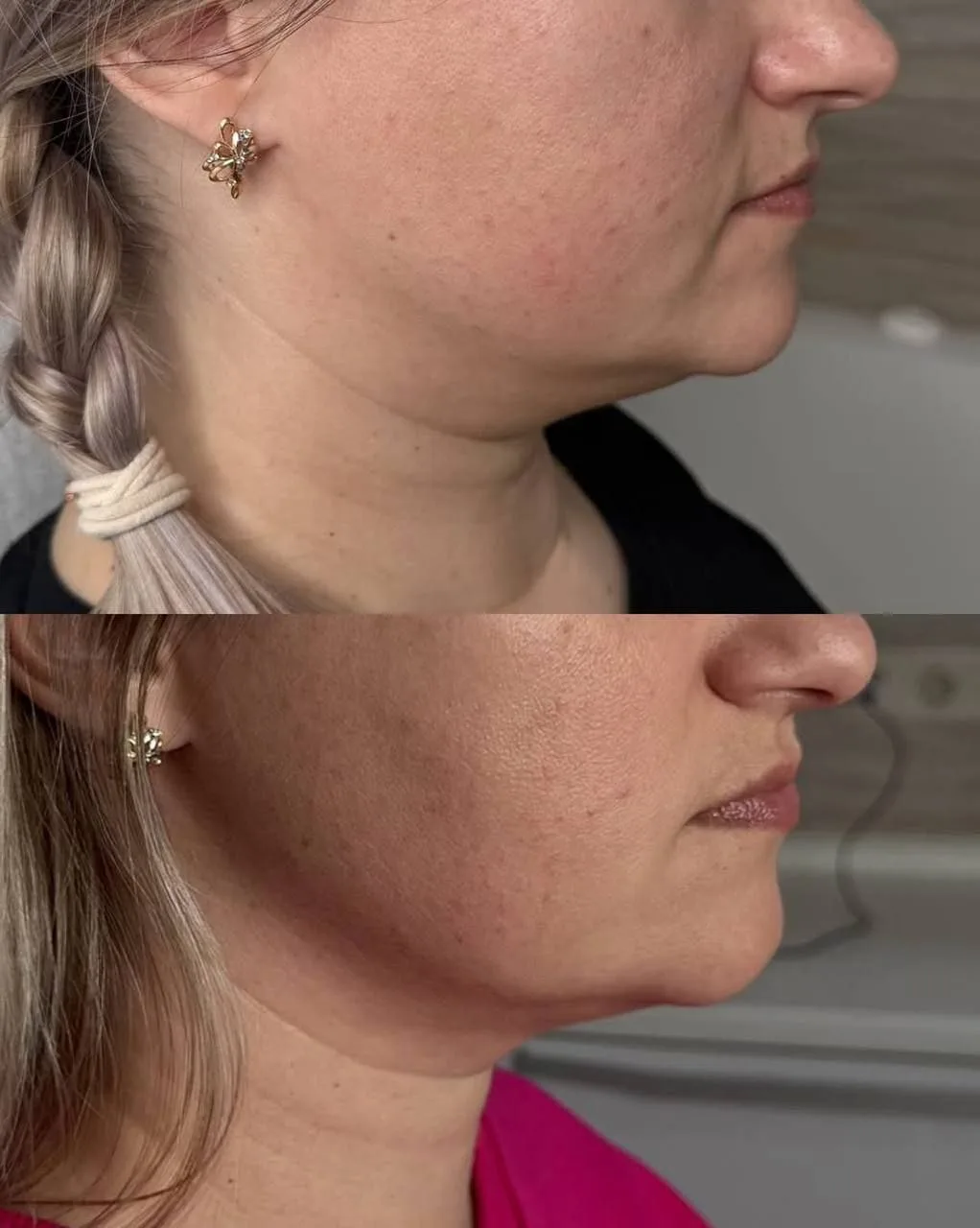 Липолитик Light fit (Лайт фит) чаще всего используют для лица. В частности, он помогает...