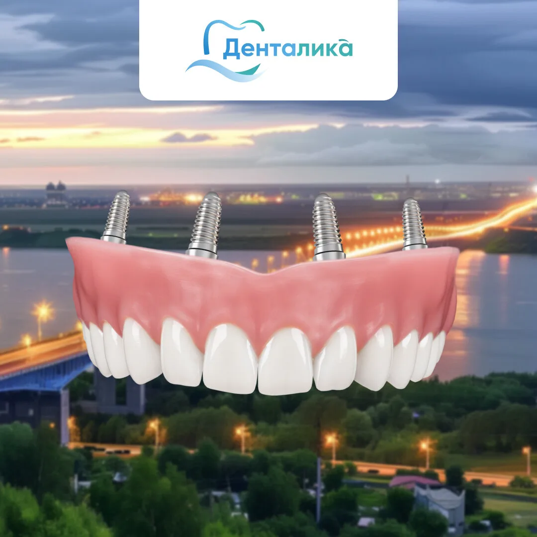Все зубы за 1 день с несъёмным протезом на 4-х имплантах
