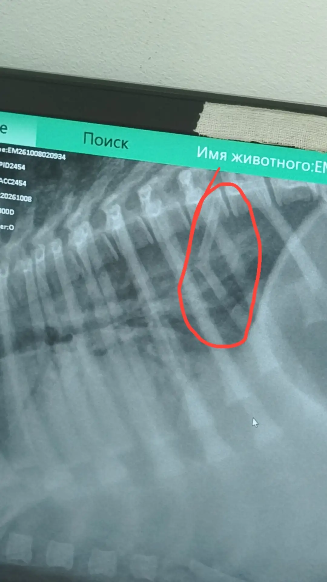 Также у малышки перелом одного ребра.