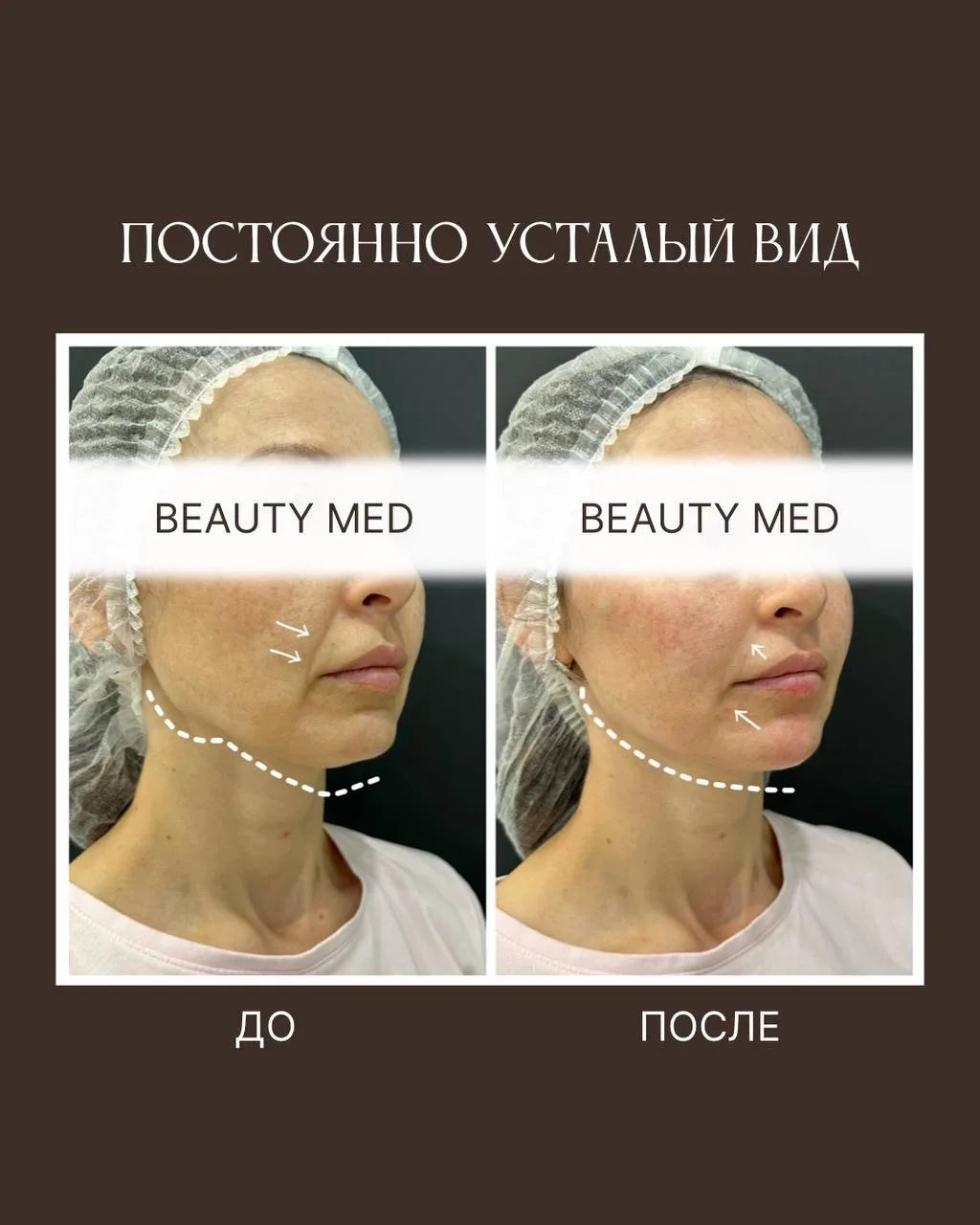 Усталое лицо — не всегда про недостаток сна...