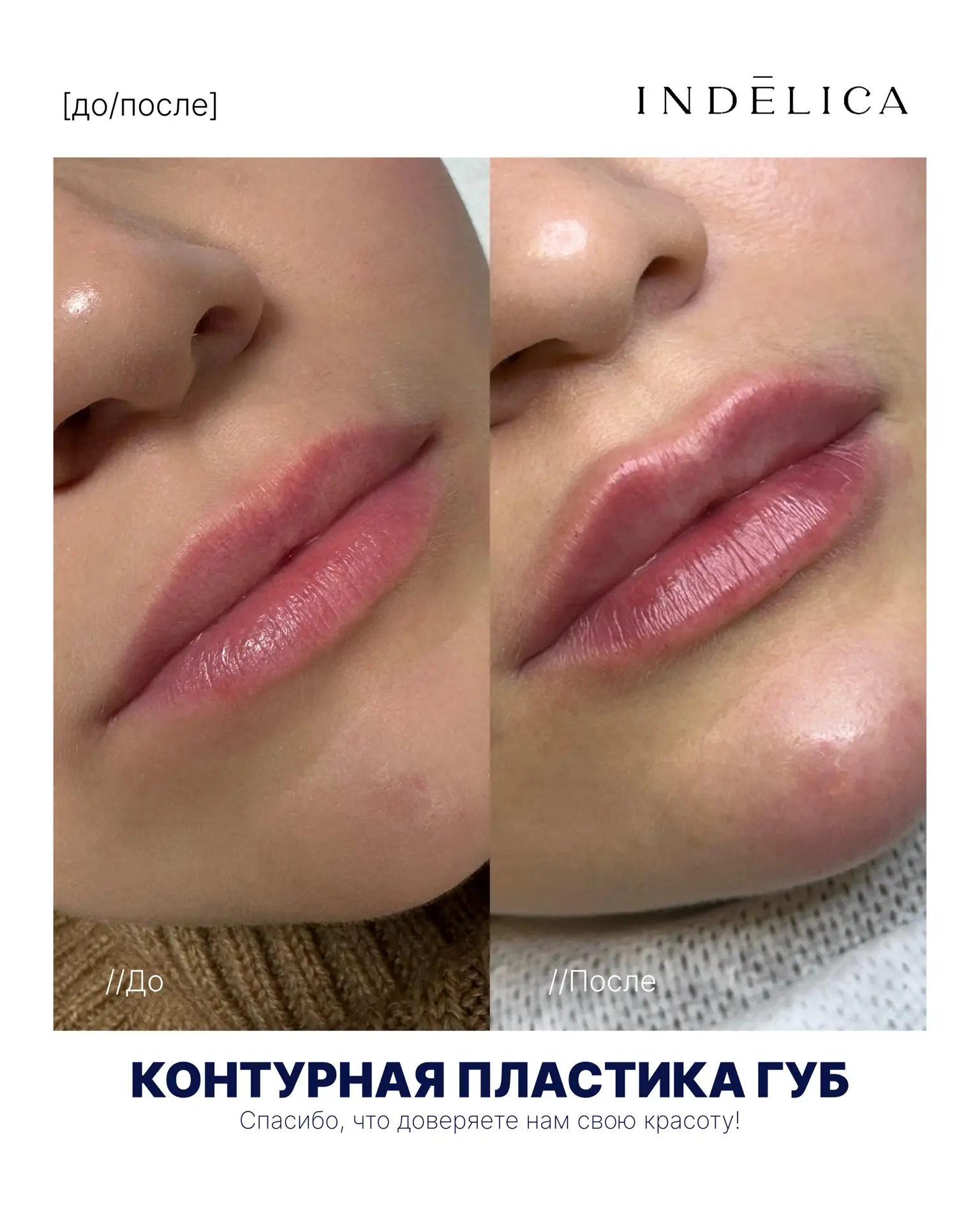 Контурная пластика губ помогает подчеркнуть естественную форму, скорректировать асиммет...