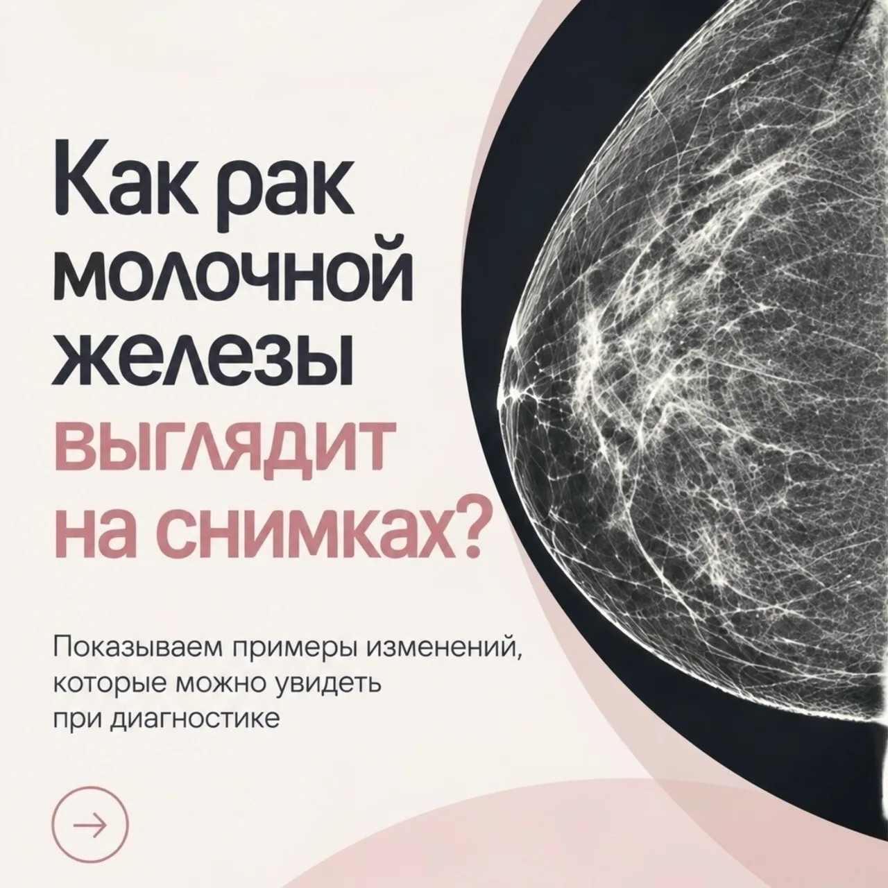 День борьбы с раком молочной железы: важность ранней диагностики